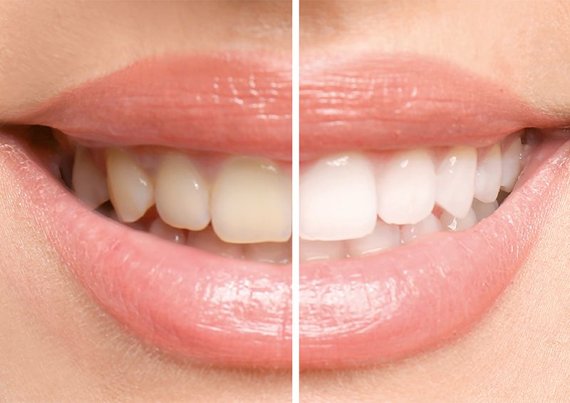 Kosmetik für deine Zähne