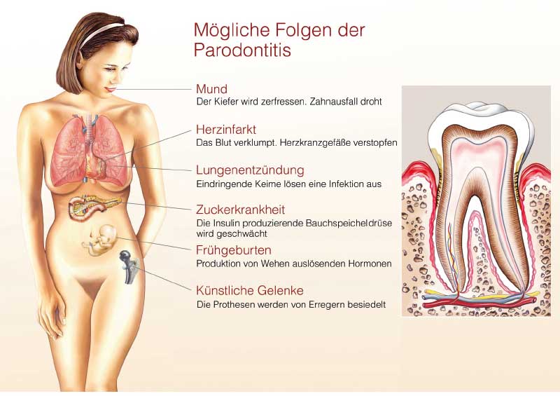 Volkskrankheit Parodontitis