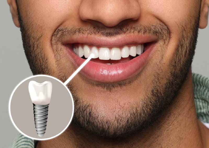 Der Weg zu langlebigem und ästhetischem Zahnersatz